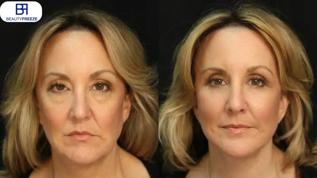 How to Get Facelift-Like Results Without Surgery?